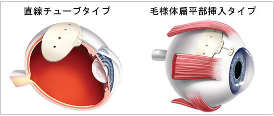 チューブシャント手術（バルベルトインプラント）