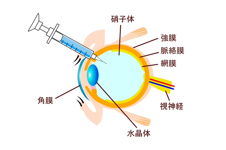 硝子体注射（抗VEGF療法）