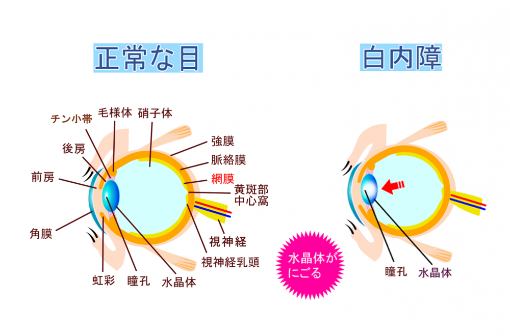 白内障 術 後 の 過ごし 方